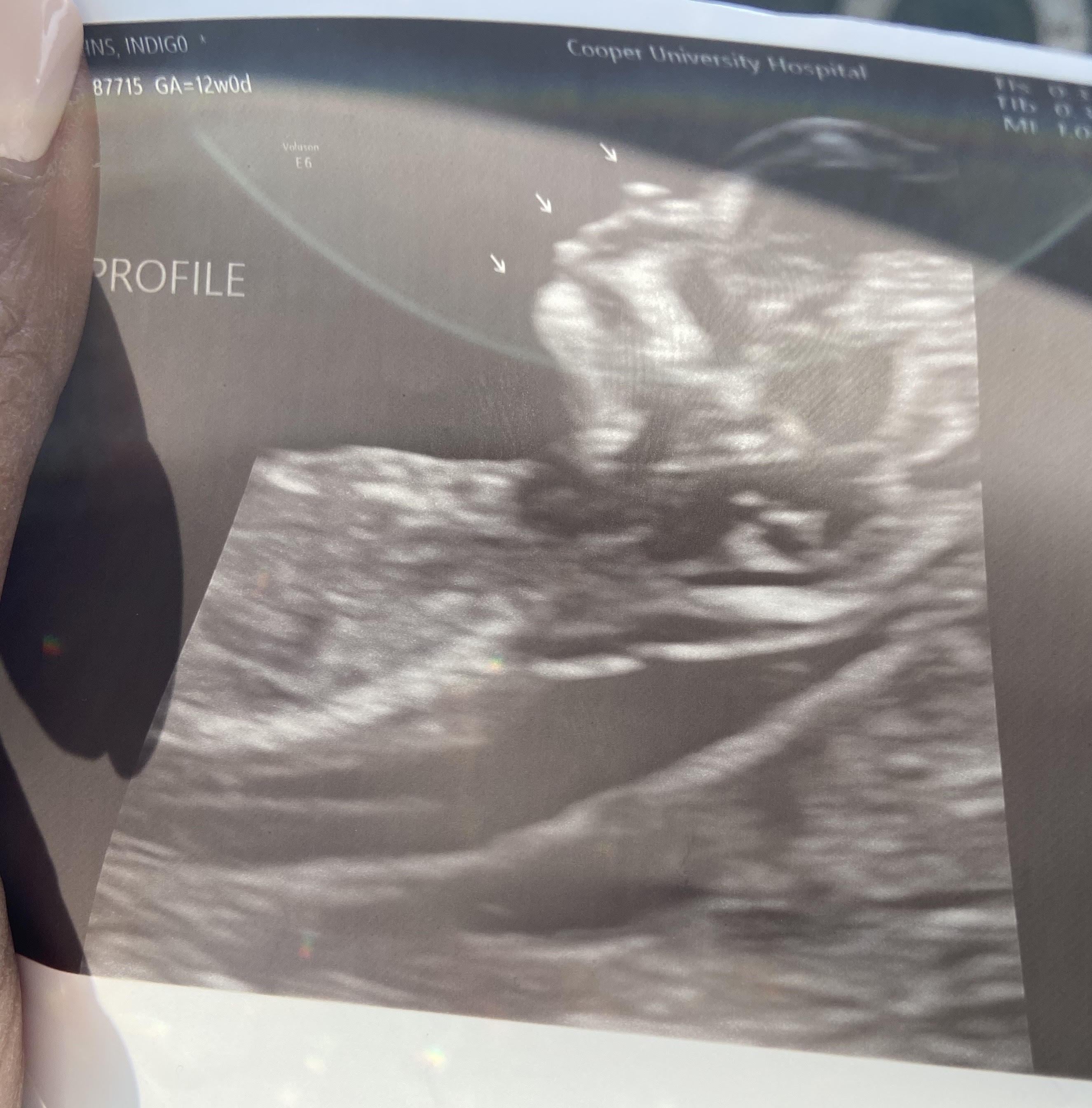 A 20 WEEK ANATOMY SCAN DURING THE PANDEMIC